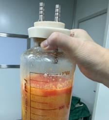 雅安水动力吸脂手术要做多久？